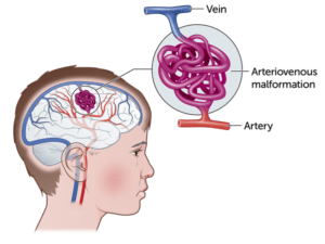 ARTERIOVENOSUS MALFORMATION ARTERIOVENOSUS MALFORMATION