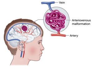 ARTERIOVENOSUS MALFORMATION