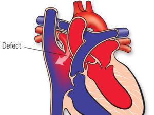 ATRIAL SEPTAL DEFECT