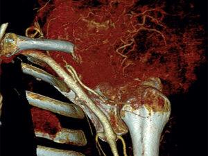 BONE METASTATSES BONE METASTATSES