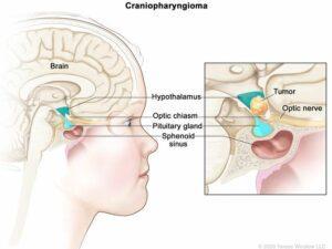 CRANIOPHAYNGIOMA CRANIOPHAYNGIOMA