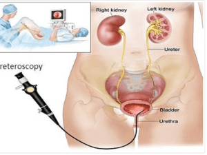 KIDNEY STONE REMOVAL