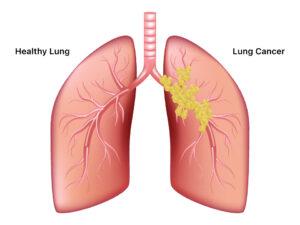 Lung-Cancer-1 Lung-Cancer-1