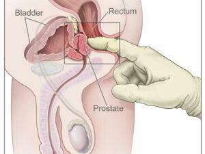 CDR457840 digital rectal exam CDR457840 digital rectal exam