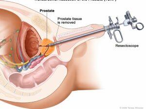 PROSTATE CANCER OPERATION PROSTATE CANCER OPERATION