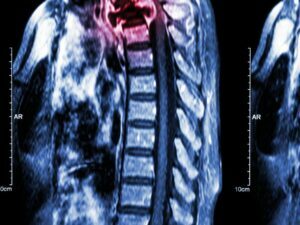 SPINAL BONE METASTATSES