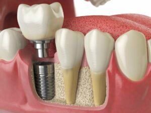 TEETH IMPLANT