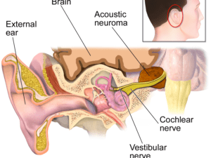 acousticneuroma acousticneuroma