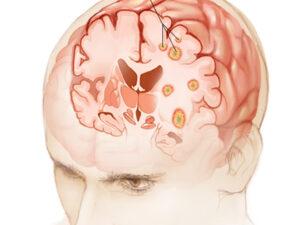 brain-metastasis brain-metastasis