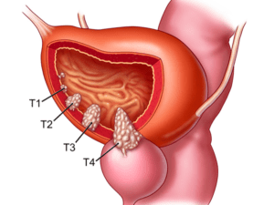 Bladder Cancer Bladder Cancer