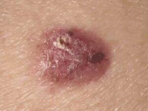 Carcinoma Carcinoma