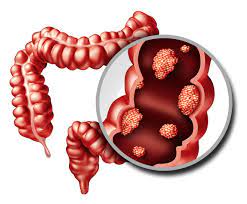 Colorectall Colorectall