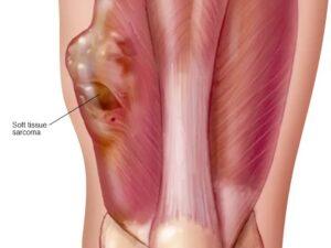 SARCOMA SARCOMA