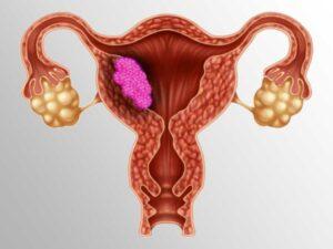 uterine-cancer-image uterine-cancer-image